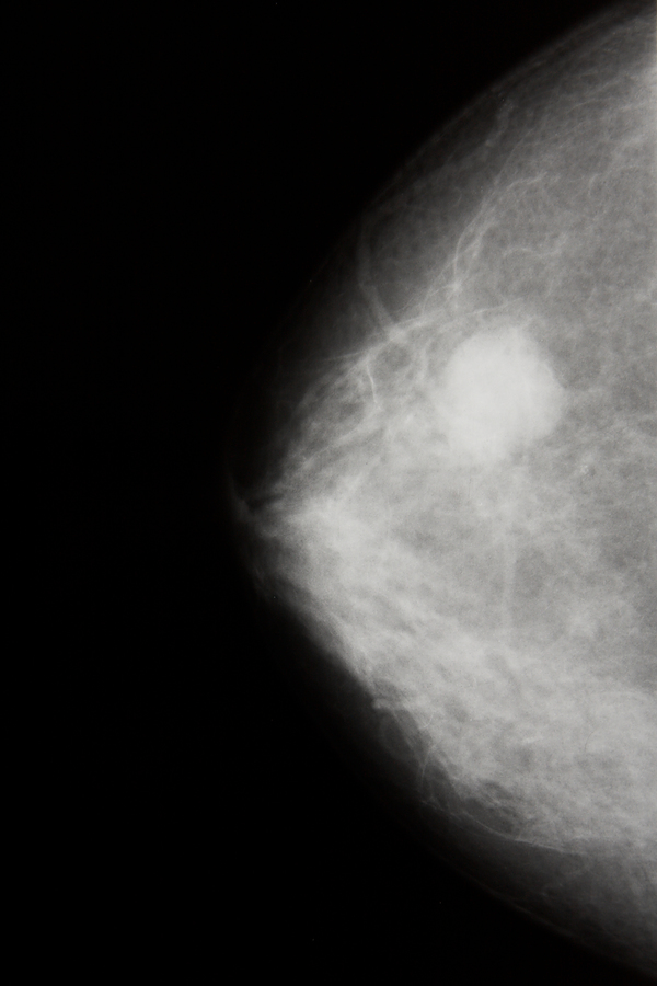 Mammogram Breast Cancer