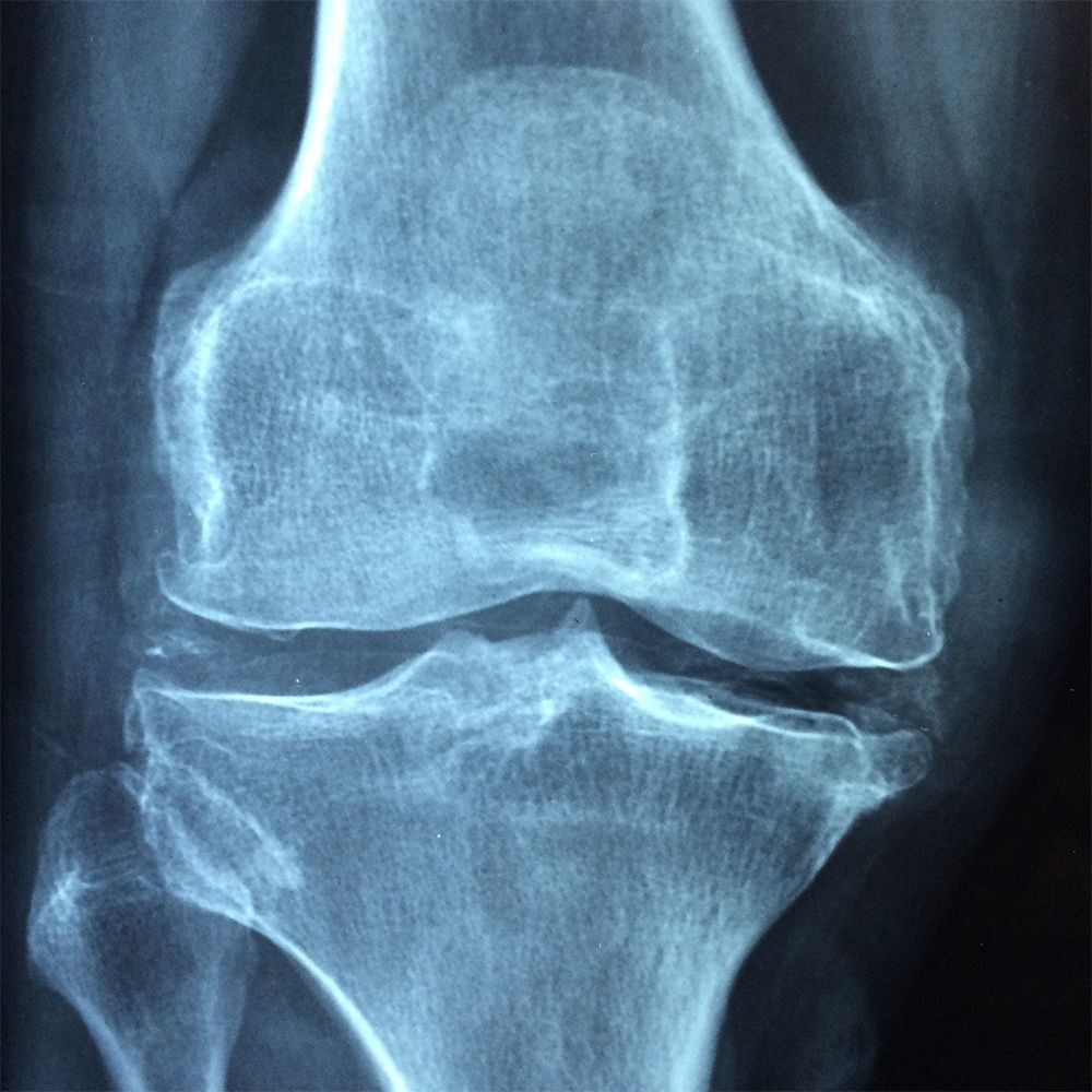 Prevent or Reverse Osteoporosis with Bio-identical Hormones