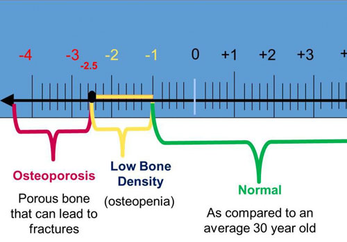 Reverse Osteoporosis with Bio-identical Hormones