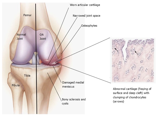 Cellular Therapy for Osteoarthritis of the Knees